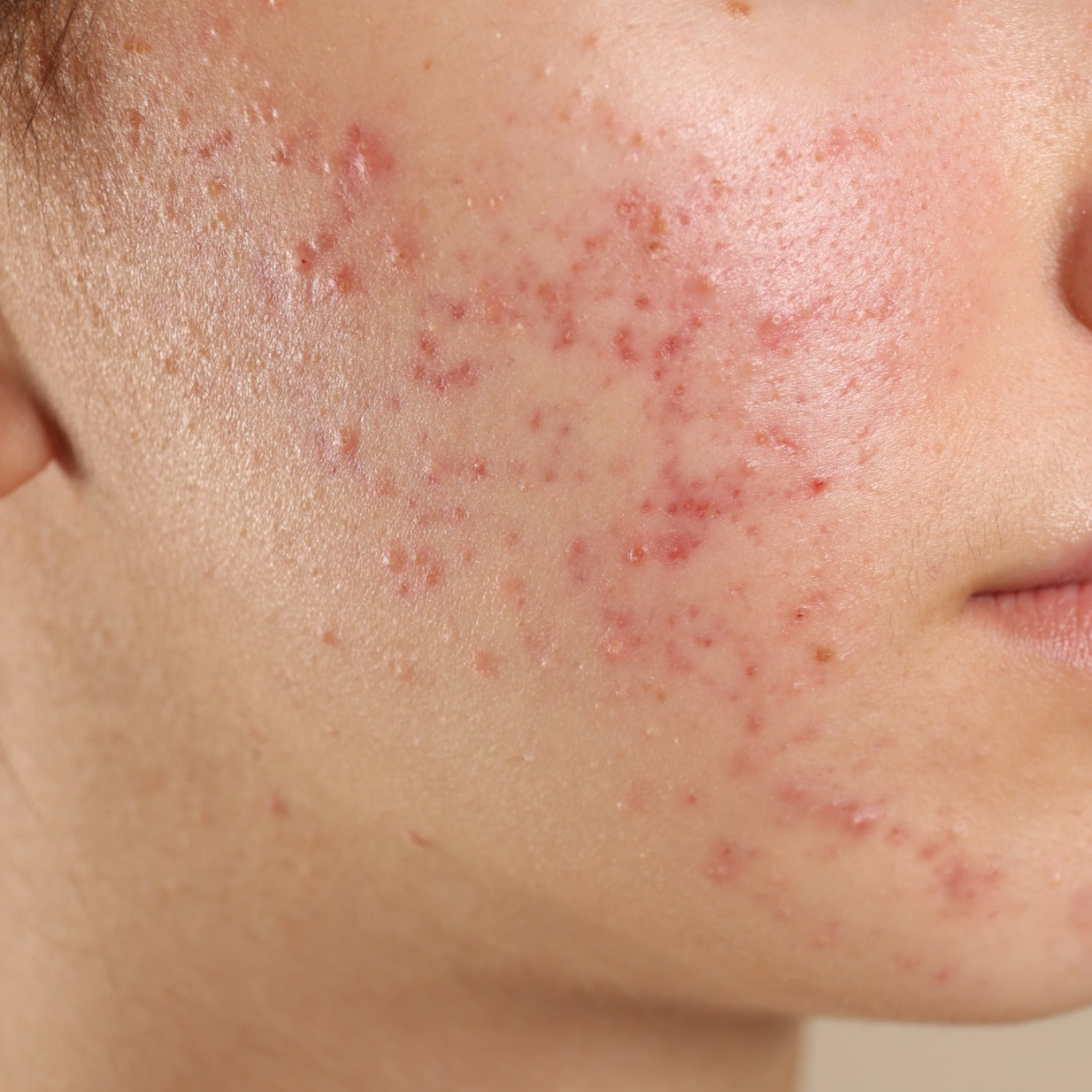 Oily & Acne Prone Skin