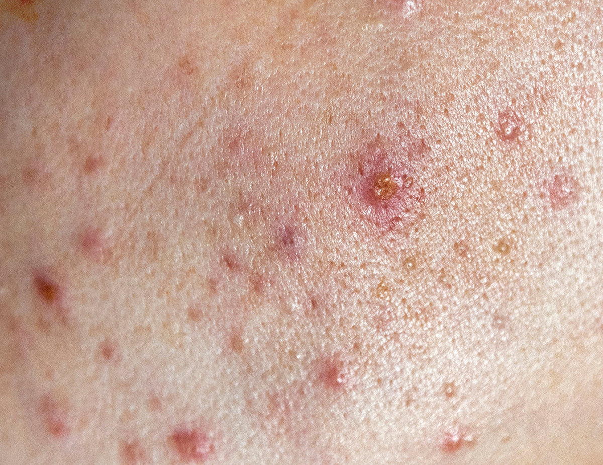 Oily & Acne Prone Skin