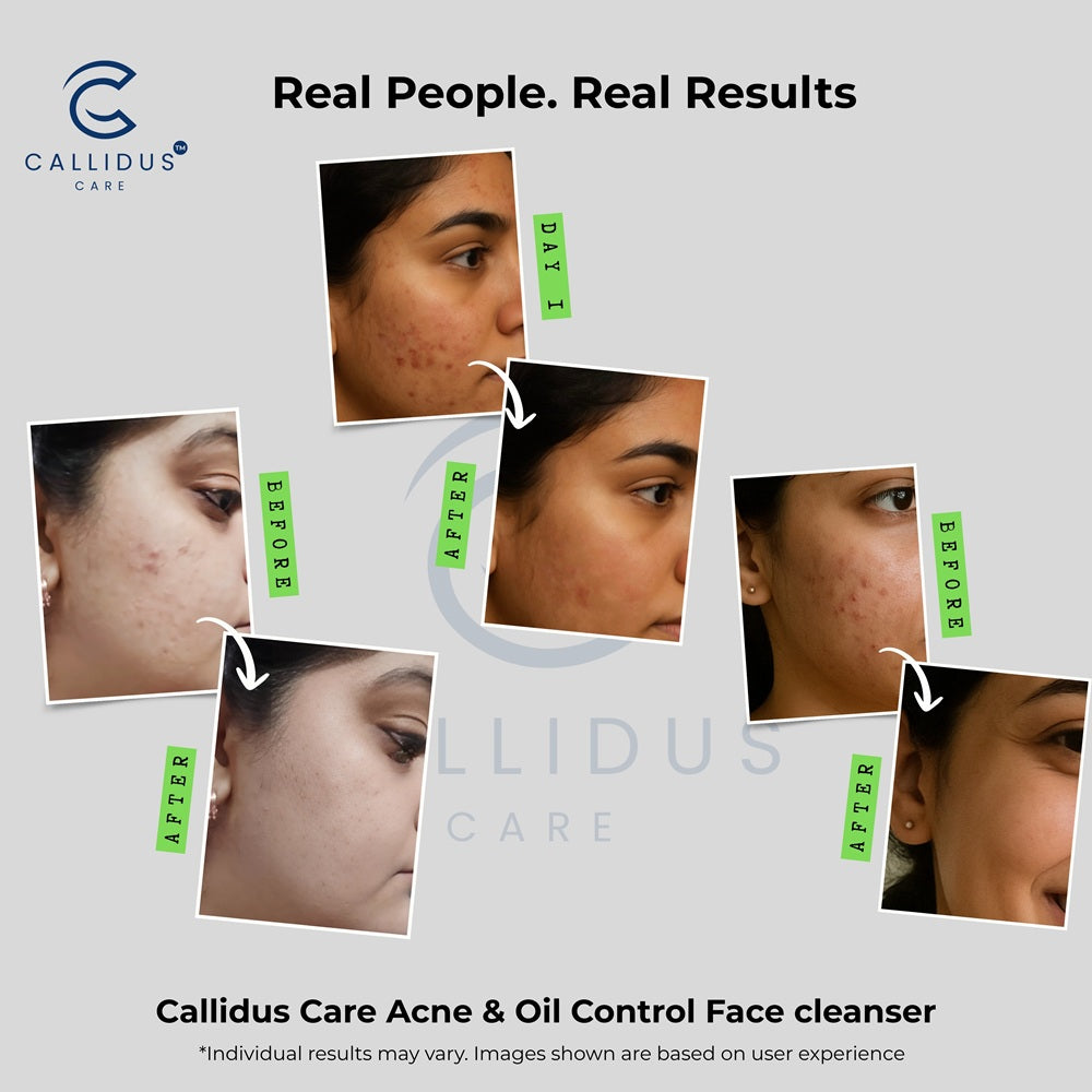 Before and after results of Callidus Care Acne & Oil Control Face Cleanser on a person's face.