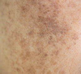 Dull & Pigmented Skin